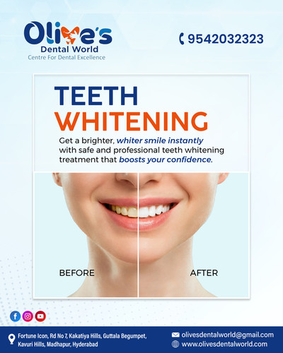Is Professional Teeth Whitening in Madhapur Safe and Effective?.jpg