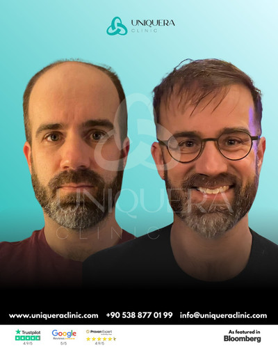 DHI Hair Transplant Turkey for Precision & Natural Results.jpg