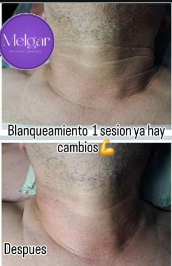 Resultados del tratamiento de blanqueamiento corporal 1