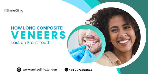 How Long Composite Veneers Last on Front Teeth.jpg