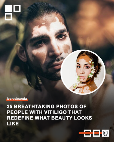vitiligo portraits people rare vitiligo beauty.png