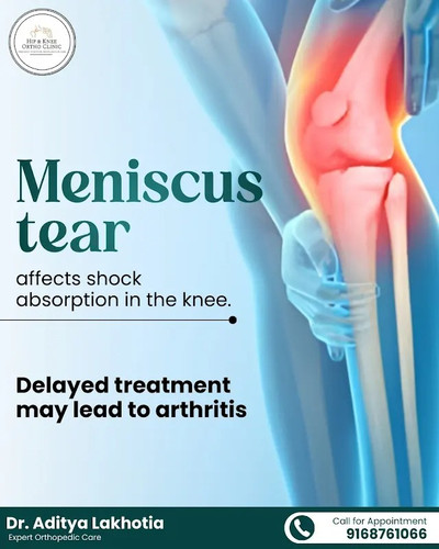 The Impact of Meniscus Tears on Knee Health and Shock Absorption.jpg