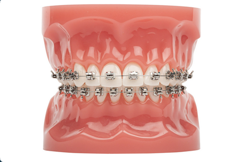 Matthews Braces.png