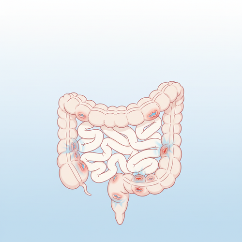 pinterest diverticulitis 1770913839589.png
