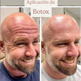 botox.png