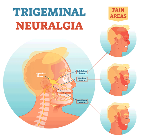 trigeminal neuralgia nerves.png