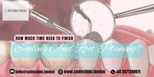 How Much Time Need To Finish Scaling And Root Planing.jpg