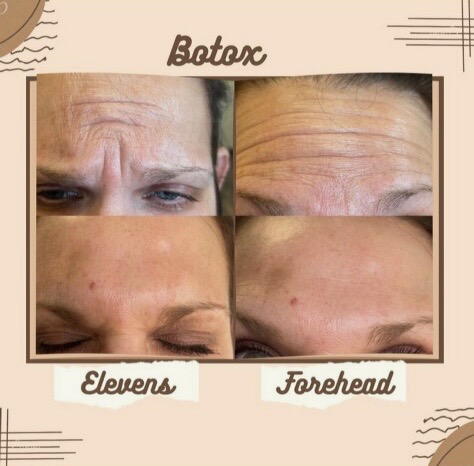 Dysport Treatment for Wrinkles | Safe & Effective Anti-Aging Solution.jpg