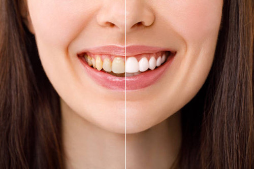 Professional Teeth Whitening in Waterford.jpg