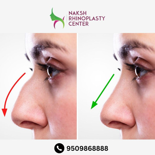 Rhinoplasty Surgery in India - Expert Nose Reshaping.jpg