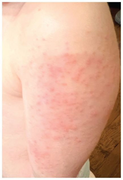 Mass People belief that Allergy Increased after COVID-19 Vaccination?