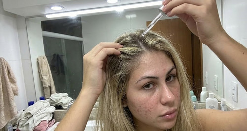 Ácido Glicólico e Hialurônico no Cabelo: Qual Comprar?