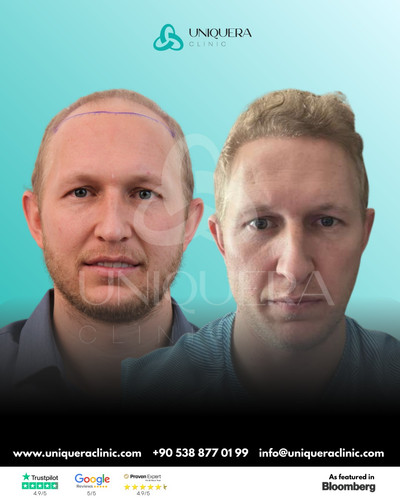 Best Clinic in Turkey for Hair Transplant – Uniquera Clinic.jpg