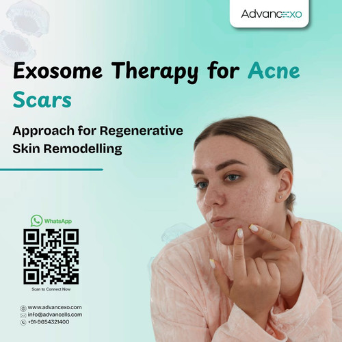 Exosome Therapy for Acne Scars.. (2).jpg