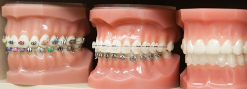 Transform Your Smile with San Antonio Adult Braces – Amini Ortho.png