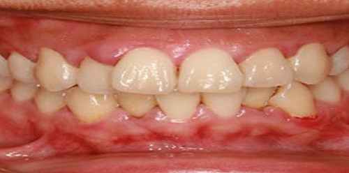 Dental Crowns Dentist Brooklyn.jpg