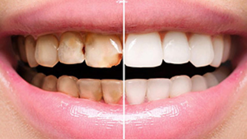 Dental Veneers Brooklyn.jpg