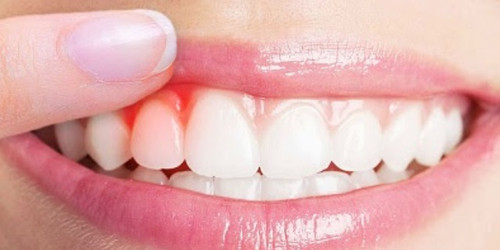Dental Crowns Dentist Brooklyn.jpg
