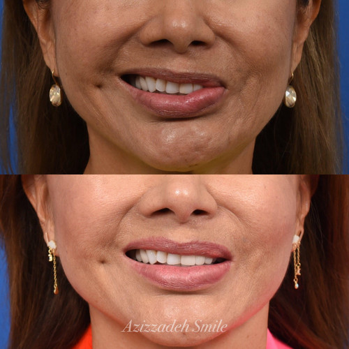Facial Paralysis Plastic Surgery CA.jpg