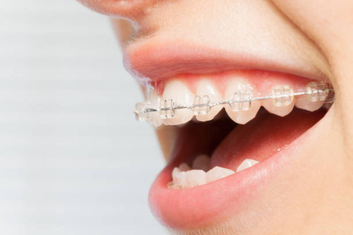 Custom Braces Treatment Plans in Vinings GA.jpg