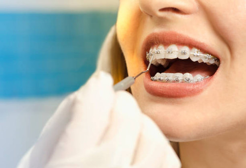Braces Near Me in Rochester NY.jpg