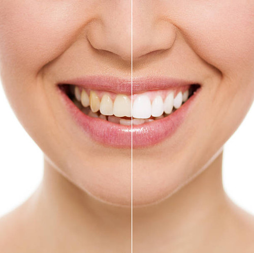 Philip M. Tornatore -Teeth Whitening Treatment Nassau County.jpg