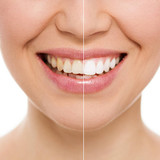 Philip M. Tornatore -Teeth Whitening Treatment Nassau County
