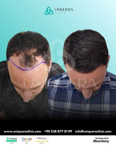 Sapphire Fue Hair Transplant Turkey.jpg