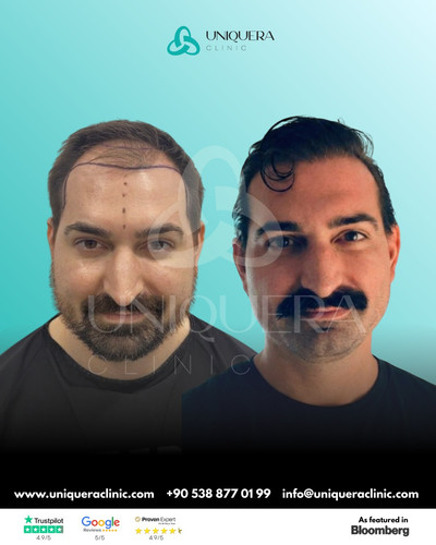 Best Hair Loss Treatment for Receding Hairline.jpg