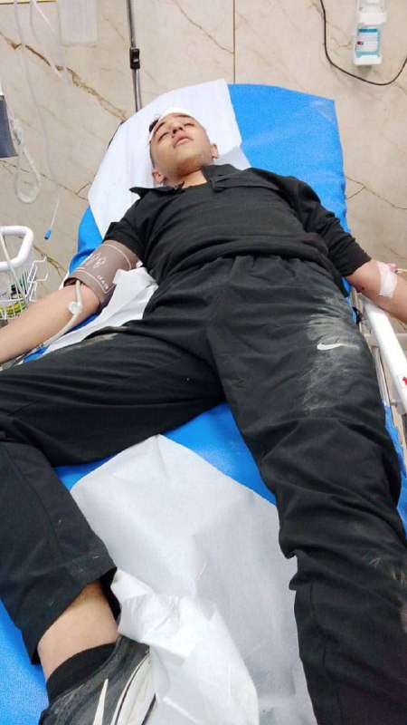 إصابة الطفل وليد جبريل مطور برصاص مطاطي جراء اقتحام جيش الاحتلال بلدة عناتا ومخيم شعفاط شمال شرق القدس المحتلة، تخلله إطلاق قنابل الصوت والغاز المسيل ...