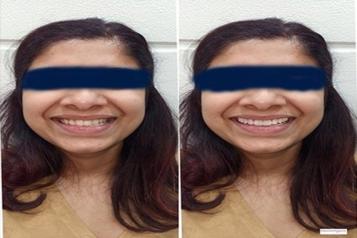 How to Recover Quickly After Root Canal Treatment in Parel.jpg