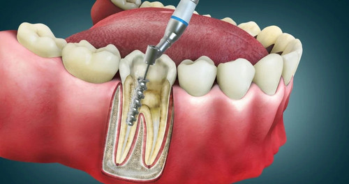 Root Canal Treatment (RCT) in Ahmedabad | Daivik Dental Clinic.jpg