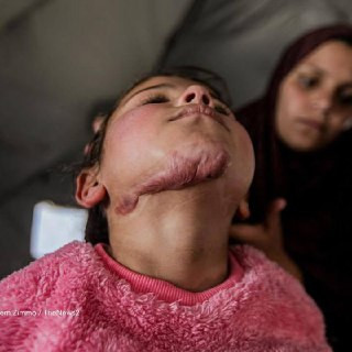 أم من غزة تناشد بإنقاذ طفلها المصاب بندوب بالغة وتلف جلدي في رقبته وصدره ناجمة عن حالة نادرة تُعرف محليًا باسم "النسيج الندبي الجدري" يعاني الطفل من آ...