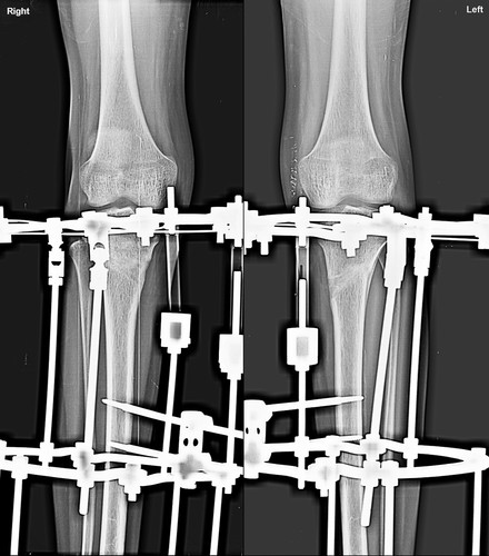 Orthopedic Deformity Correction for Limb & Joint Alignment - Trishla Ortho.jpg