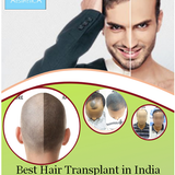 Best Hair Transplant in India.png