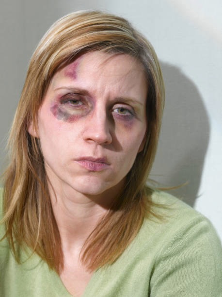 35yr old woman after domestic violence.jpg