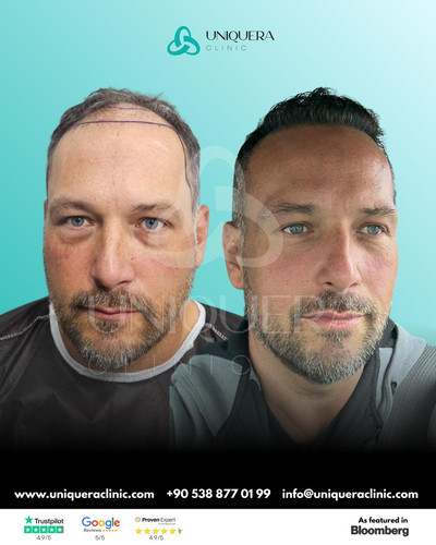 Advanced Receding Hairline Transplant for Natural & Permanent Results.jpg