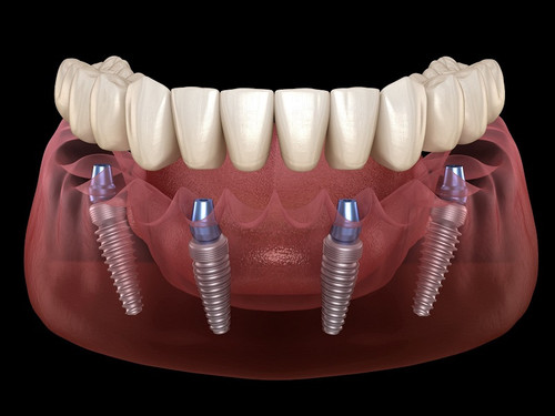 All on 4 dental implants tijuana Mexico.jpg