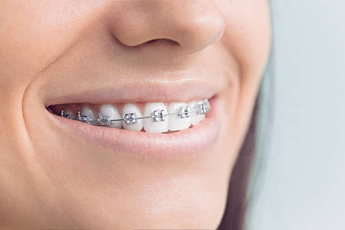 Braces Consultation Traverse City MI.jpg