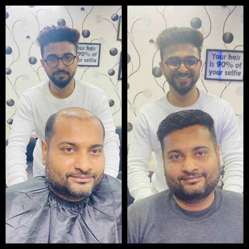 Best Hair Replacement Service  - Indian Hair World Siliguri.jpg