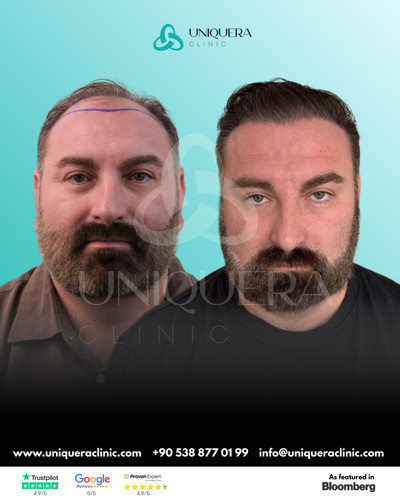 FUE Hair Transplant Istanbul – Restore Your Hair UniquEra Clinic.jpg