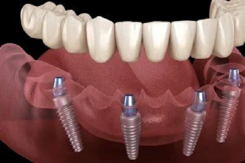 Implant Dentist Albany.jpg