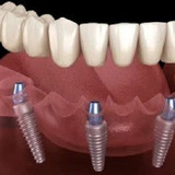 Implant Dentist Albany