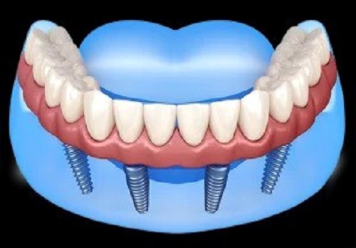 Implant Dentist Albany.jpg