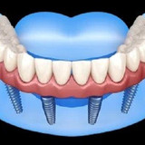 Implant Dentist Albany