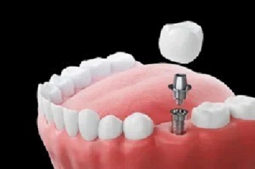 Implant Dentist Albany.jpg