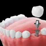 Implant Dentist Albany