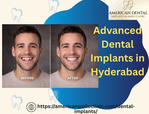 Advanced Dental Implants in Hyderabad.jpg