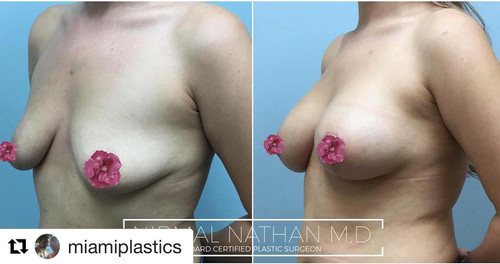 Suria Plastic Surgery & Medspa
595 S Federal Hwy #130
Boca Raton, FL 33432
(561) 338-3343

https://suriaplasticsurgery.com/fort-lauderdale/