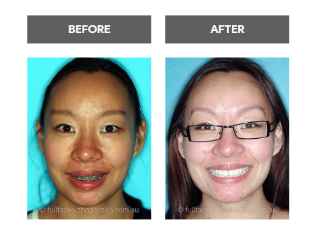 Get Your Teeth Straighten and Braces from the Orthodontist in Sydney.png